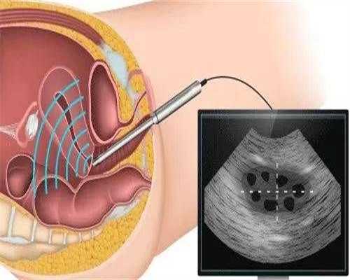 试管费用为何差距如此之大