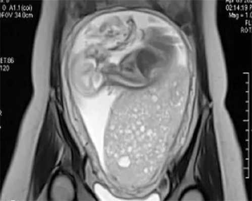 试管代怀宝宝:移植怀孕后hcg翻倍不好宫内有出血，该怎么保胎呢？