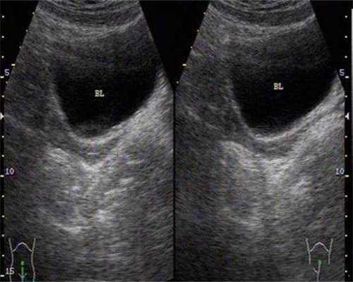 同房后多久可以查hcg值