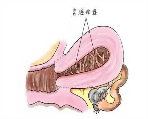 试管供卵助:多囊AMH值20是严重多囊吗